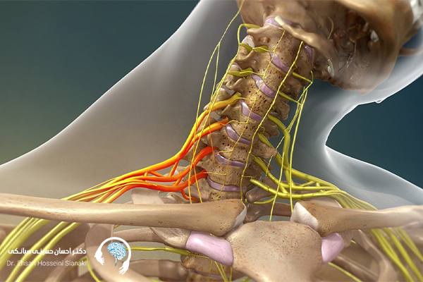 کاردرمانی در درمان آسیب براکیال